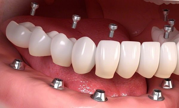 Несъемное протезирование зубов Имплант Сити