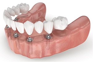 Несъемное протезирование зубов Имплант Сити